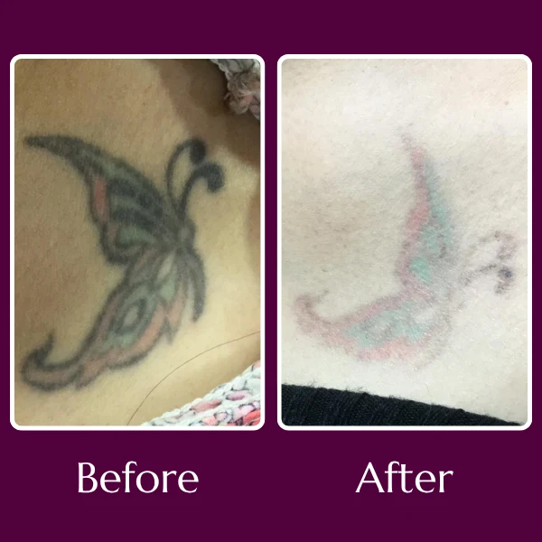 Tattoo Removal
