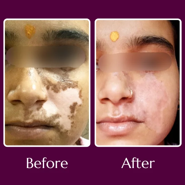 melanocyte transplantation