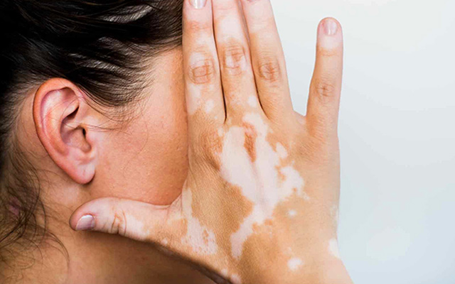 Guide For Vitiligo Treatment