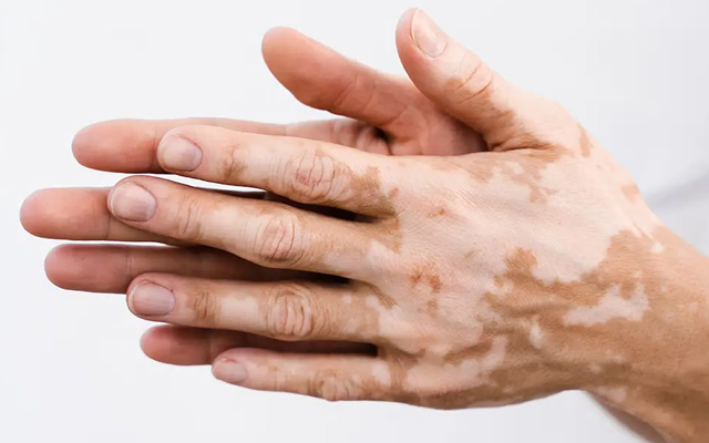 10 Early Signs of Vitiligo: When Should You Consult a Doctor