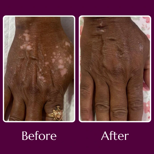 Vitiligo-before-after-RH