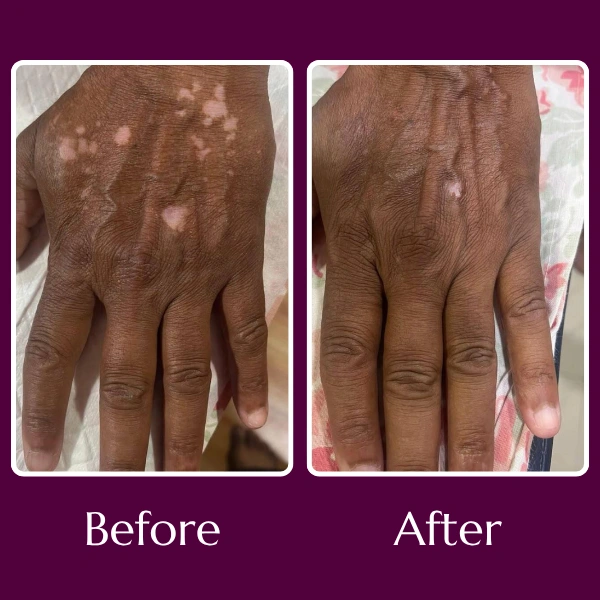 vitiligo-before-after-LH