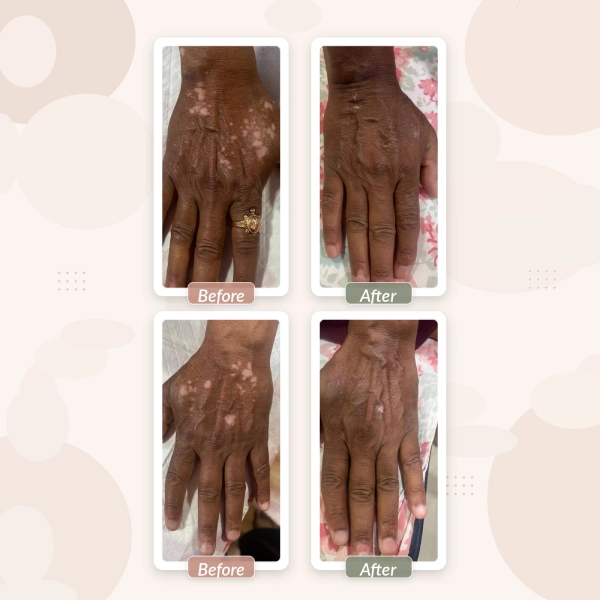 vitiligo-before-after-hands