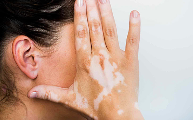 Common Mistakes in Vitiligo Care and How to Avoid Them 