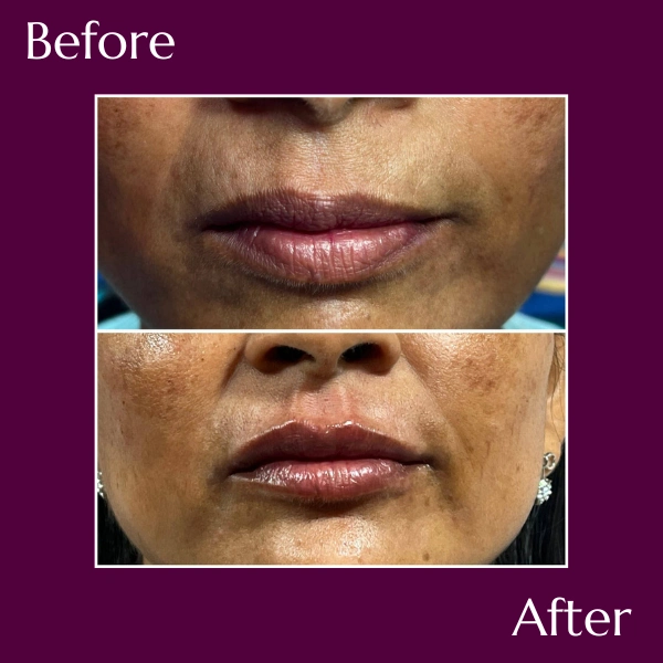 Lip Fillers