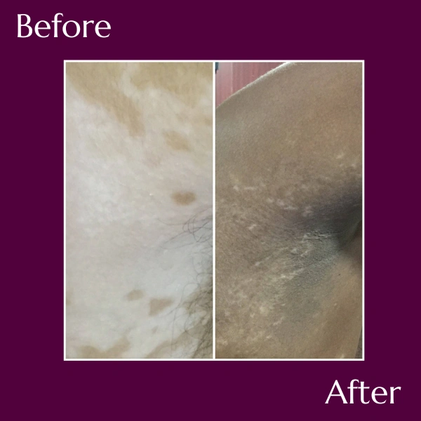 Vitiligo