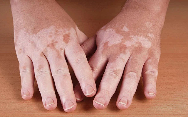How Dermatologists Track Vitiligo Improvement Over Time