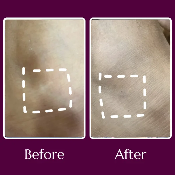 Vitiligo before & after