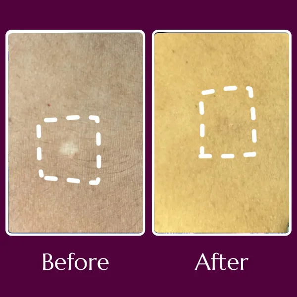 Vitiligo before & after