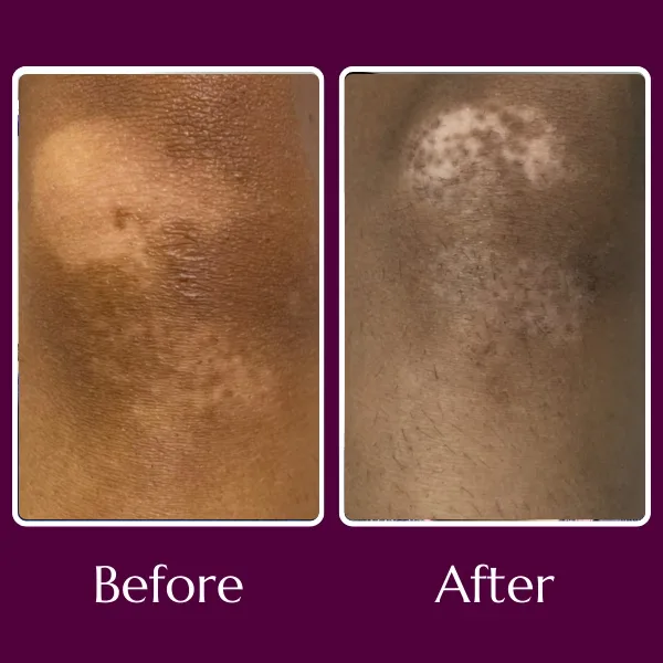 Vitiligo before & after