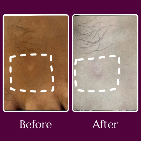 Vitiligo before & after
